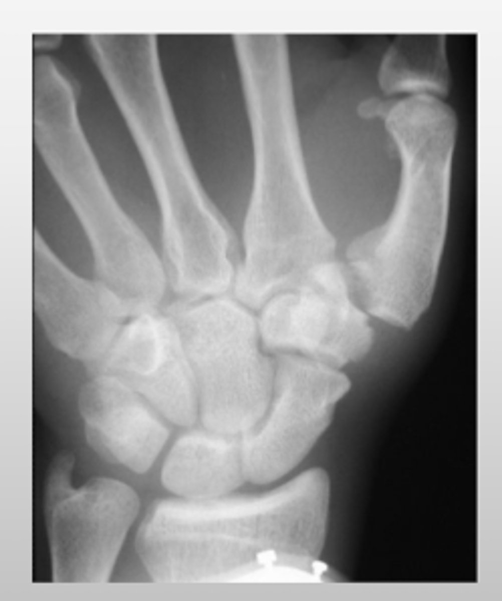 <p>base of the 1st metacarpal</p>
