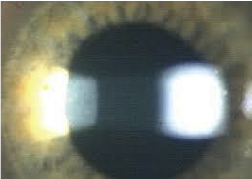 <ul><li><p>Magnification: 16X then 25X</p></li><li><p>Beam Height: 1-3 mm</p></li><li><p>Beam Width: 1-3 mm</p></li><li><p>Filter: OUT</p></li><li><p>Angle: 45</p></li></ul><p></p>