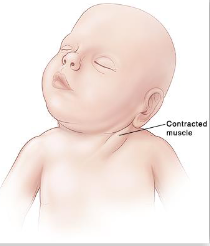 <ul><li><p>head laterally flexes to the affected side </p></li><li><p>chin rotates away from the affected side</p></li><li><p>patient presents with limited ROM, both in flexion of head and neck</p></li><li><p>Right SCM is more common than left.  </p></li></ul><p></p>