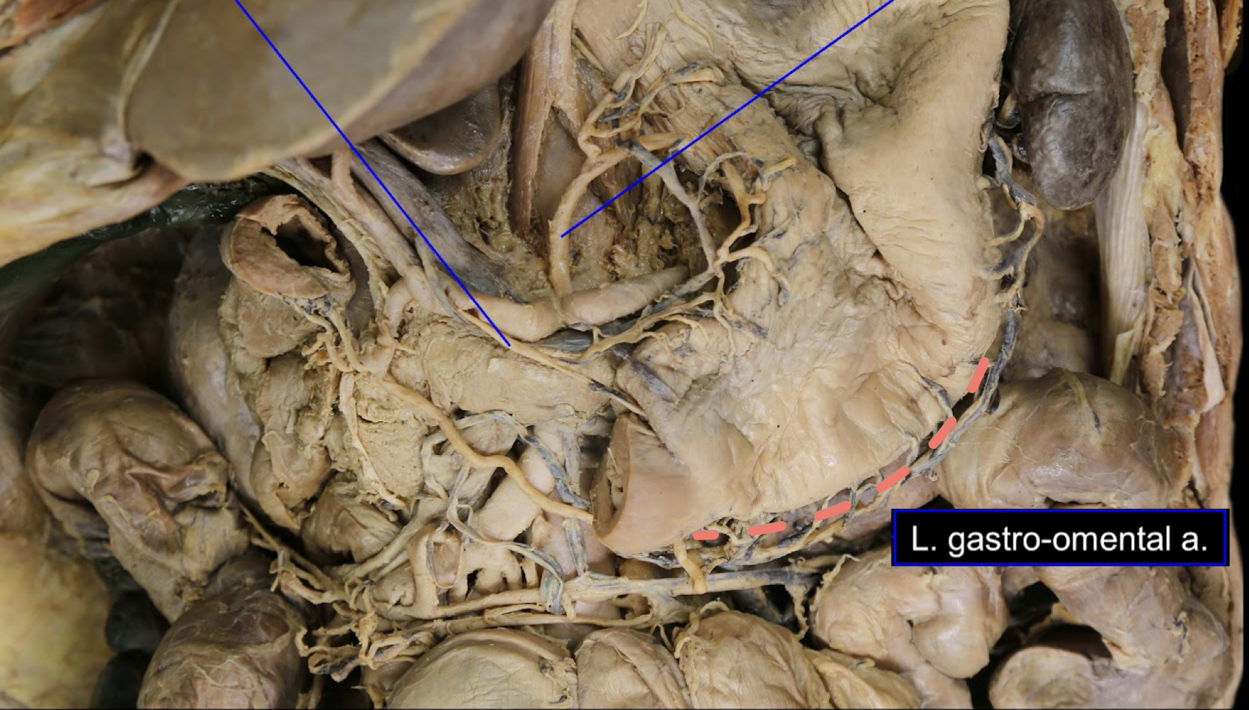 <p>A). greater curvature of the stomach<br>B). left gastroomental artery</p>