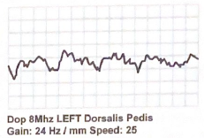 <p>Describe the following pedal waveform:</p>