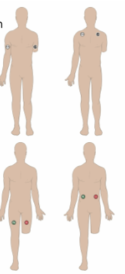 <ul><li><p> A patient who has had a limb amputation or who has an injury that limits access to a limb requires adapted electrode placement</p></li><li><p>The key for adaptations is that the electrode for the corresponding, unaffected limb should be placed in a mirror position</p></li></ul><p></p>