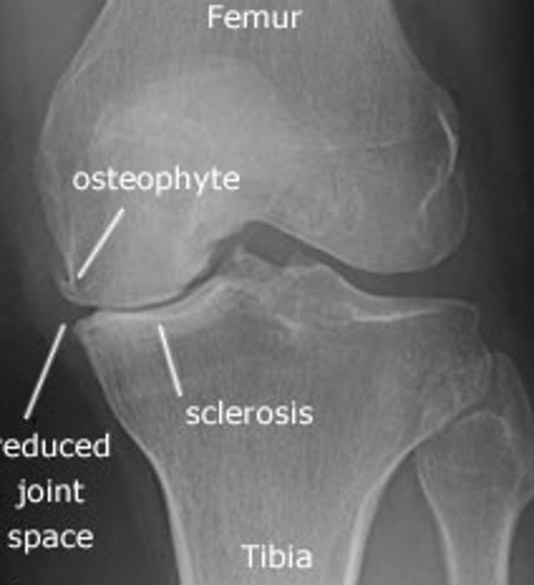 <p>Routine x-ray of the affected joints is not usually needed to confirm diagnosis</p><p>Consider arranging x-ray (depending on clinical judgement)</p><p>X-ray (weight bearing)</p><p>Loss of joint space</p><p>Osteophytes</p><p>Subchondral cysts</p><p>Subchondral sclerosis </p>