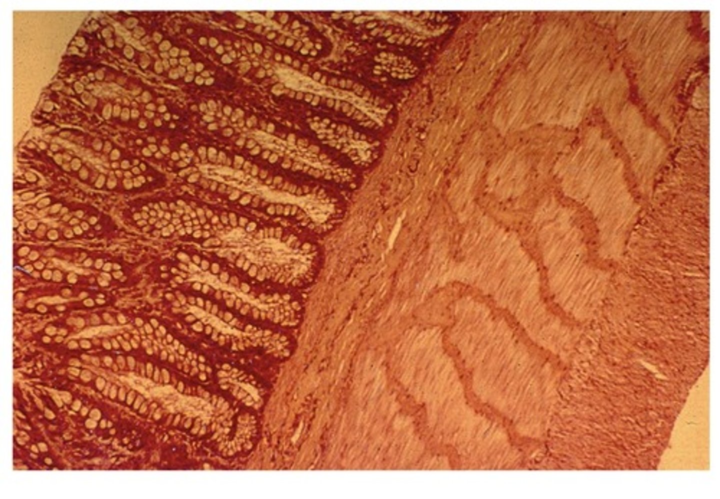 <p>no villi, lots of goblet cells</p>