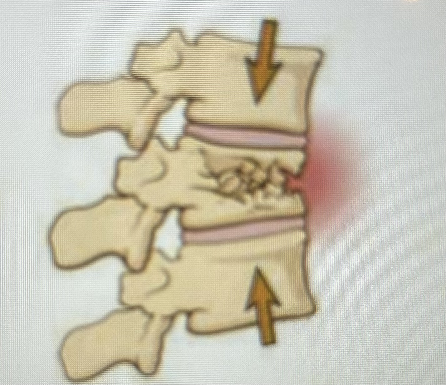 <p>What type of fracture is this?</p>