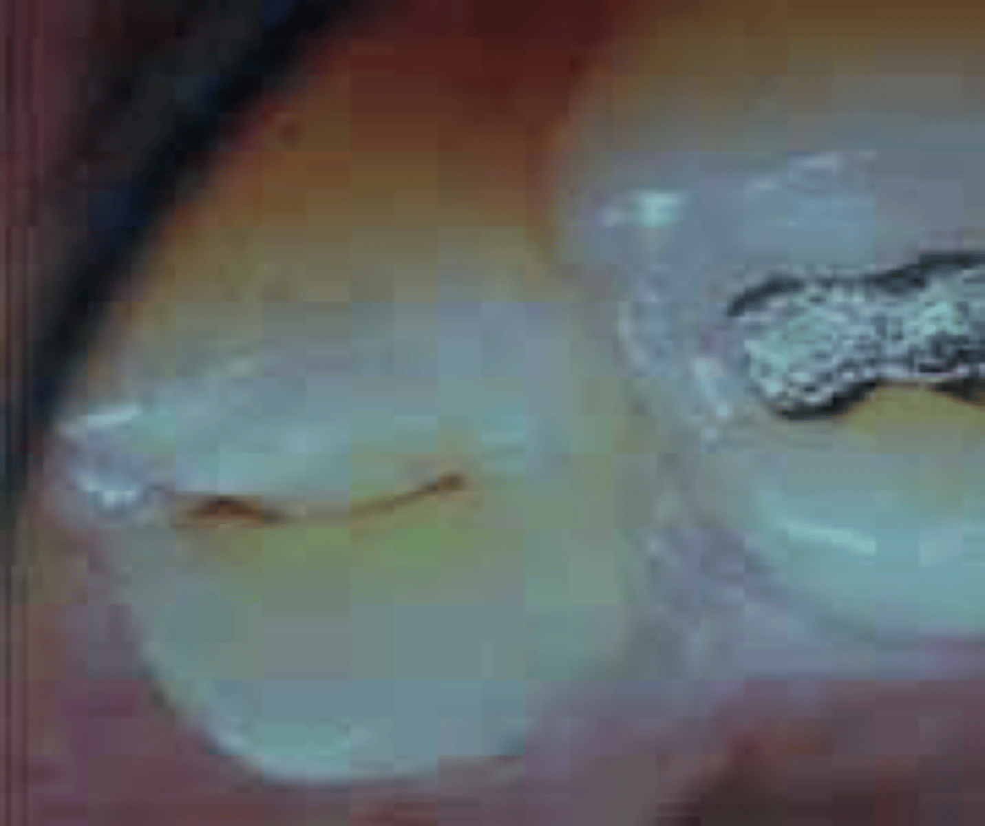 <p>Occurs in endings of grooves of teeth (buccal groove of mand. molars; occlusal pits molars/premolars)</p><p>Minute faults in enamel</p>