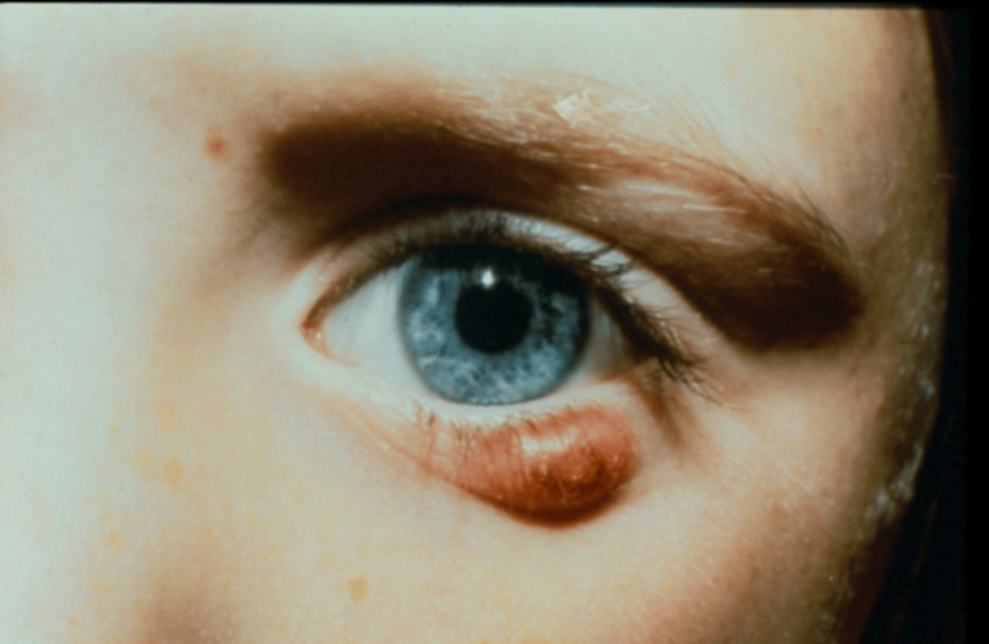 <p>What condition does this patient most likely have?</p>