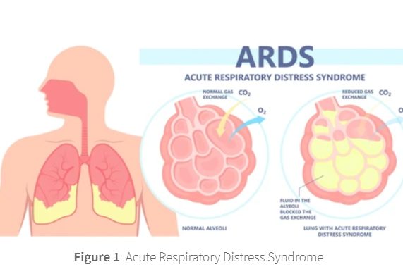 <p><span><span>ARDS usually occurs in people who are already critically ill or have major injuries, many of which will already be inpatients in hospital with related disease. The severity of ARDS means that most patients will not survive, with an increased mortality rate observed in the elderly. Of the people who survive ARDS, some fully recover, but others have chromic resulting lung damage.</span></span></p>