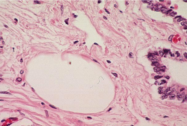 <p>Lymphatic vessel. The lymphatic vessel in this slide is dilated, making it much easier to recognize.</p><ul><li><p>endothelial cell nuclei surrounding lumen</p></li><li><p>lumen is too large to be a capillary</p></li></ul><p></p>