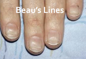 <p>Ridging, transverse: more than one extremity (Beau’s lines)</p>