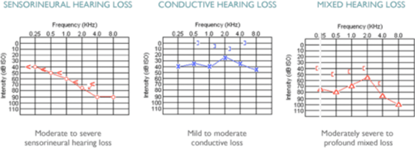 <p>In mixed hearing loss both air and bone conduction are impaired, with air conduction often being 'worse' than bone</p>