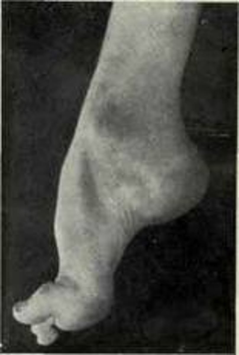 <p>Toe is in a down position, DF limitation of ankle</p>