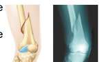 <p>Fracture resulting from twisting forces applied to the bone</p><p>(An illustration and an X ray of a spiral fracture in the upper leg</p>