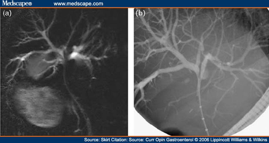 <p>Generalized dilatation of intrahepatic bile ducts to level of hilum</p>