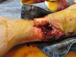 <p>Compound fracture</p>