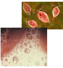 <p>it is <strong>thin, foamy, and foul-smelling</strong> vaginal discharge</p>