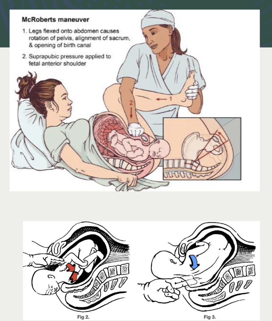<ul><li><p>The provider should identify the shoulder</p></li><li><p>RN notes the time / starts a timer</p></li><li><p>RN calls for extra assistance STAT</p><ul><li><p>labor and delivery team</p></li><li><p>NICU</p></li><li><p>neonatal team</p></li><li><p>maybe anesthesia if needed</p></li></ul></li><li><p>1st line</p><ul><li><p>McRobert’s maneuver and suprapubic pressure</p></li></ul></li><li><p>2nd line</p><ul><li><p>hands and knees or posterium</p></li></ul></li></ul><p></p>