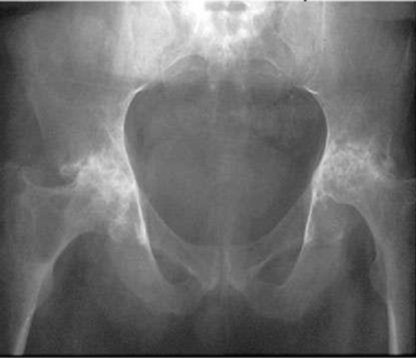 <p>systemic autoimmune inflammatory disorder which causes destruction of periarticular tissue</p><p>STRUCTURES--&gt; joint capsule, ligaments, articular cartilage, tendon and muscle</p><p>FUNCTIONAL DEFICITS--&gt; loss of ROM, strength, pain, swelling</p><p>COMPENSATORY MOVEMENTS--&gt; joint protection via unweighting (assistive device, need to watch areas of pressure)</p>
