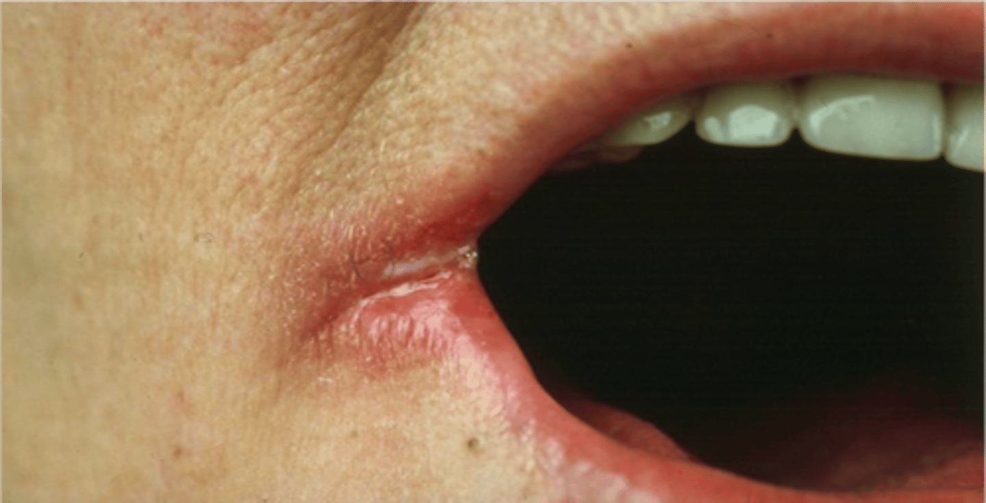 <p>What causes angular cheilitis?</p>