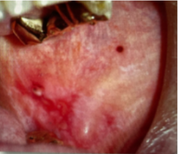 <p>FORM OF LICHEN PLANUS ON BUCCAL MUCOSA</p>