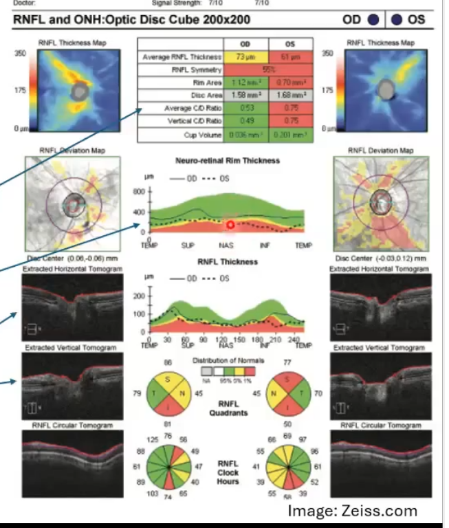<p>A scans taken, using a raster scan approach capturing the disc and peripapillary area </p><p>building up like a 3 cube </p><p>typically around 200 × 200, 6mm x 6mm on the retina </p><p>can be used to analyse disc topography and surrounding RNFL thickness </p><p>measurements of rim/disc area, C/D ratio, cup volume </p><p>horizontal and vertical scan through onh centre </p><p></p>
