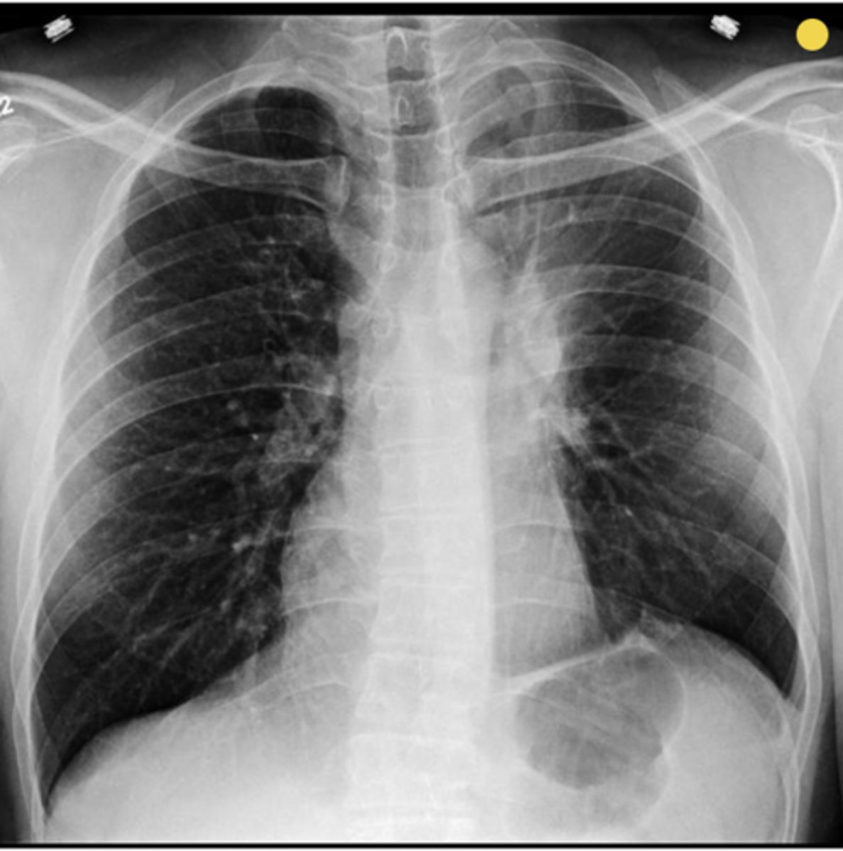 <p>Name the sign present in this case</p>