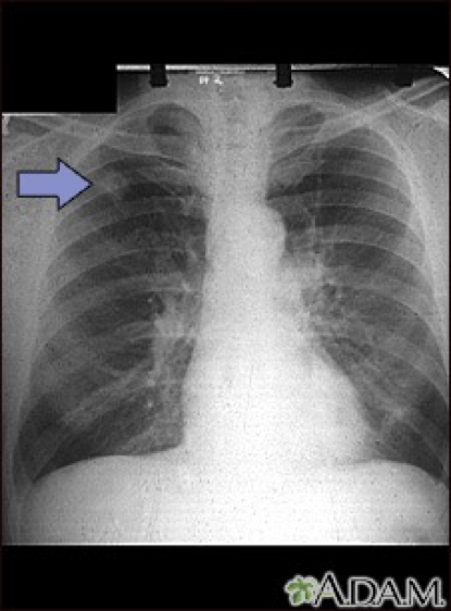 <p>Type of lung cancer commonly occurring peripherally</p>