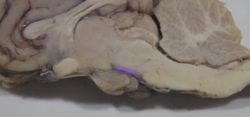 <p>Cerebral Peduncles </p>