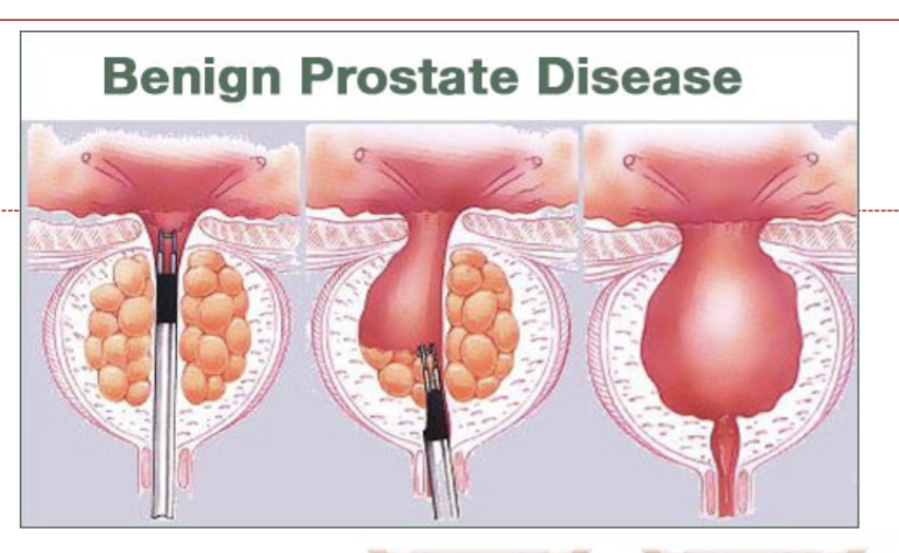 <ol><li><p>transurethral resection of the prostate</p></li><li><p>a scope is inserted through the urehthra to cut away excess prostate tissue to relieve obstruction</p></li><li><p>VERY BLOODY! because it cut each small area of tissues at a time</p></li></ol><p></p>