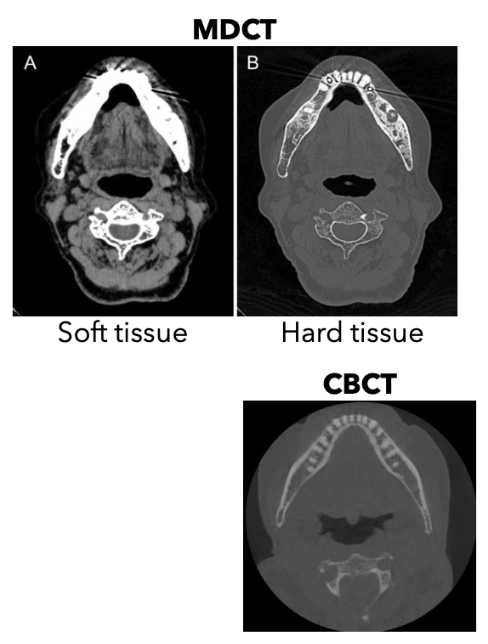 <p>It has a higher/better contrast resolution</p><ul><li><p>It enables soft tissue eval that is not possible with CBCT</p></li><li><p>IV contrast improves detection of soft tissue conditions due to enhancement (inflammation, malignancy, lymph node involvement)</p></li></ul><p></p>