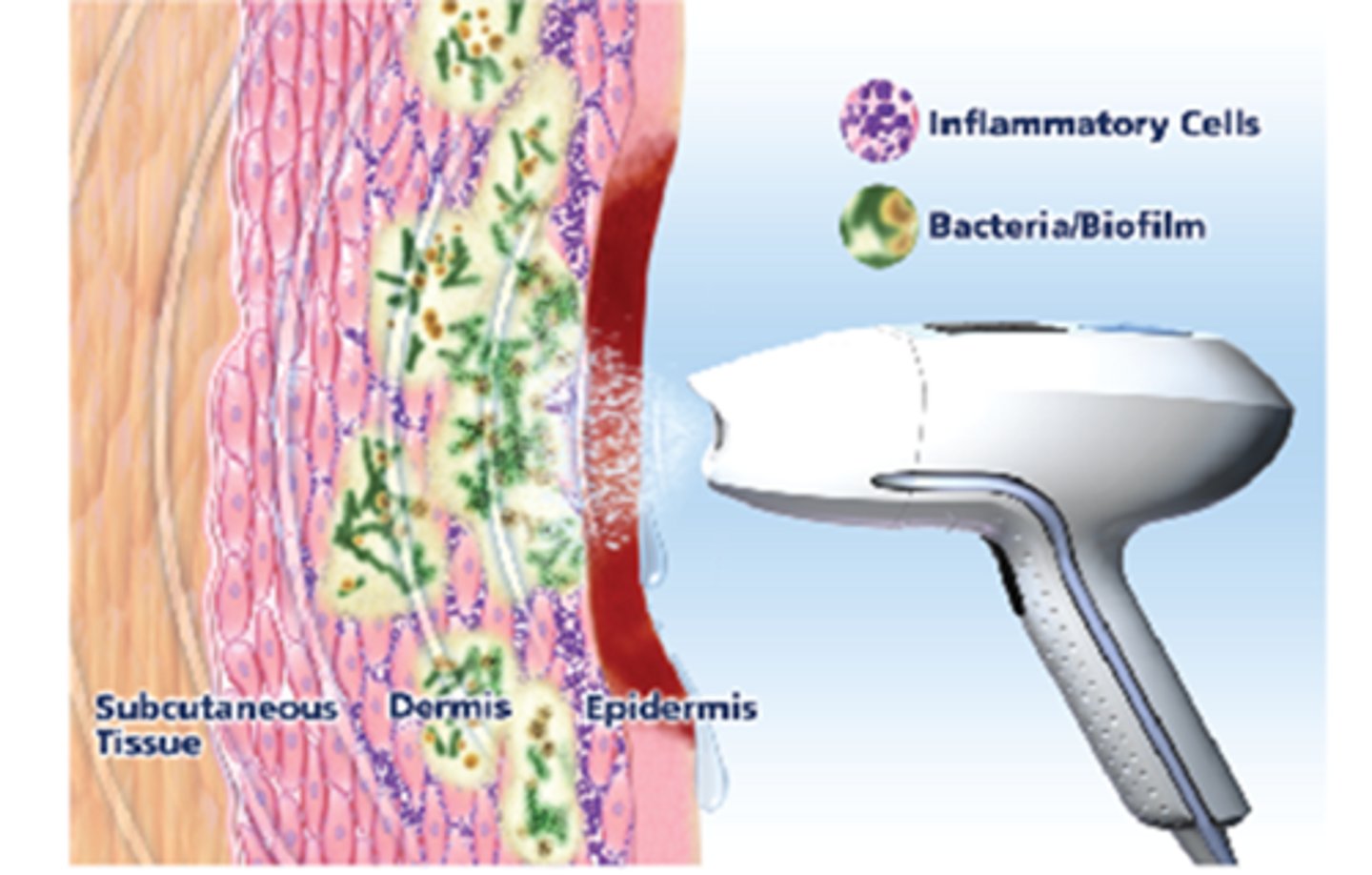 <p>WOUND HEALING MODALITY</p><p>non-contact, using saline (MIST)</p><p>- reduces bioburden </p><p>(microbial load of contaminated organisms)</p><p>- microstreaming</p><p>- promotes cavitation </p><p>(BUBBLES = NORMAL)</p>
