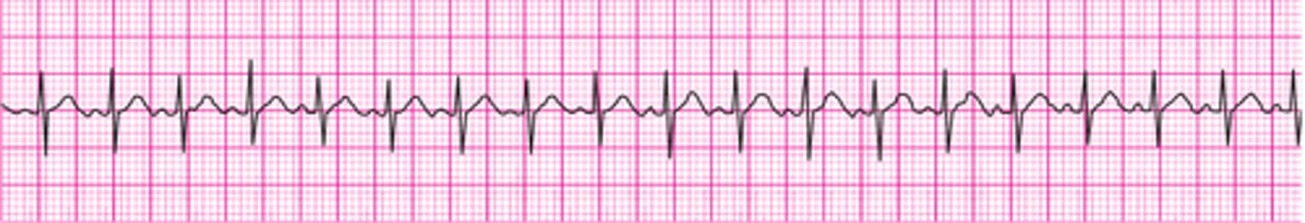 <p>Sinus tachycardia</p>