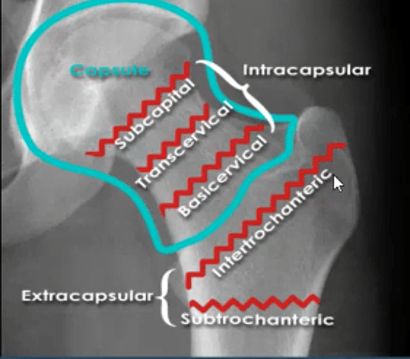 <p>intracapsular:</p><p>head</p><p>neck ( subcaptial, midcervical, basic cervical)</p><p>*worse outcomes</p><p>extracapsular:</p><p>intertrochanteric</p><p>subtrochanteric</p>
