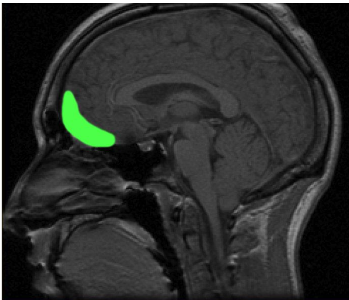 <p>A functional part of the<strong> prefrontal cortex</strong>, sometimes referred to as ventromedial.</p>