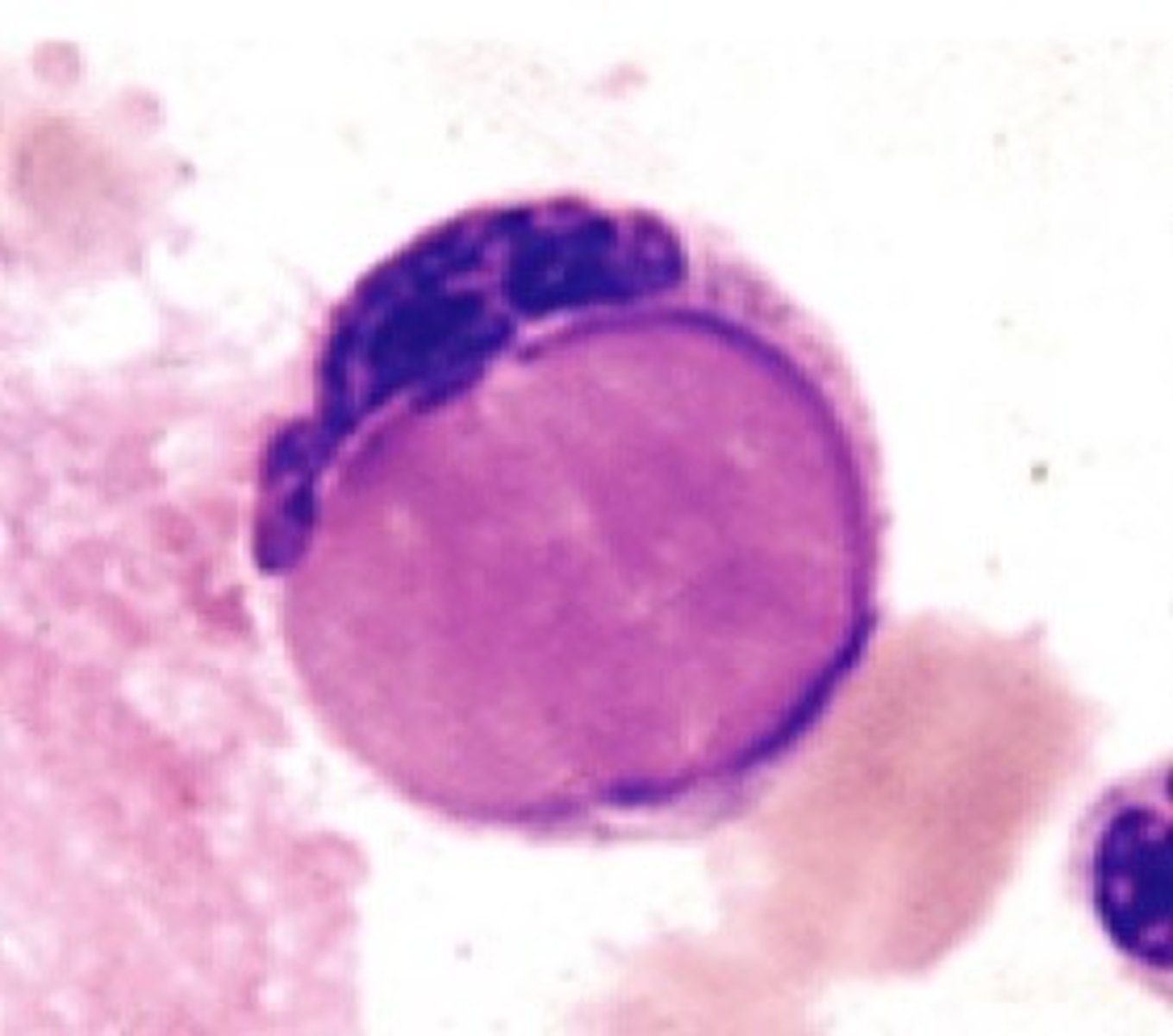 <p>red-purple inclusions distending from the cytoplasm; a neutrophil/macrophage that has phagocytize denatured material from another cell; NOT NATURALLY OCCURRING!!!</p>