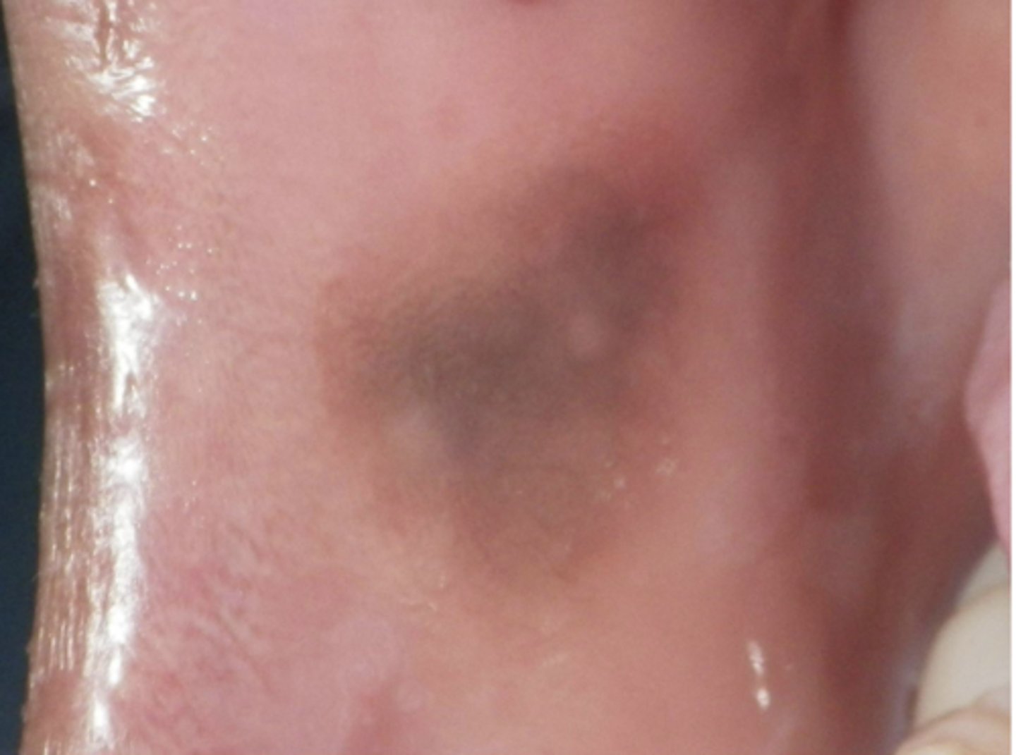 <p>What type of pigmented lesion?</p><p>- Rare acquired pigmented lesion(s) of rapid onset</p><p>- Reactive?</p><p>- May reach several cm in size</p>