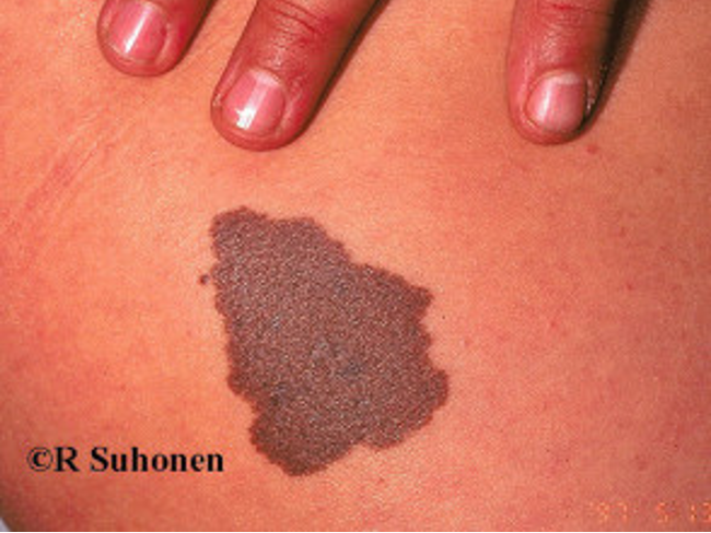 <p>hamartomas composed primarily of benign melanocytes during embryogenesis</p><p>present at birth and grows w/ child</p>