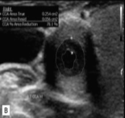 <p>This was seen at the patient’s aorta.&nbsp;</p><ol><li><p>How does it appear sonographically?</p></li><li><p>What pathology can be assumed here?</p></li></ol><p></p>
