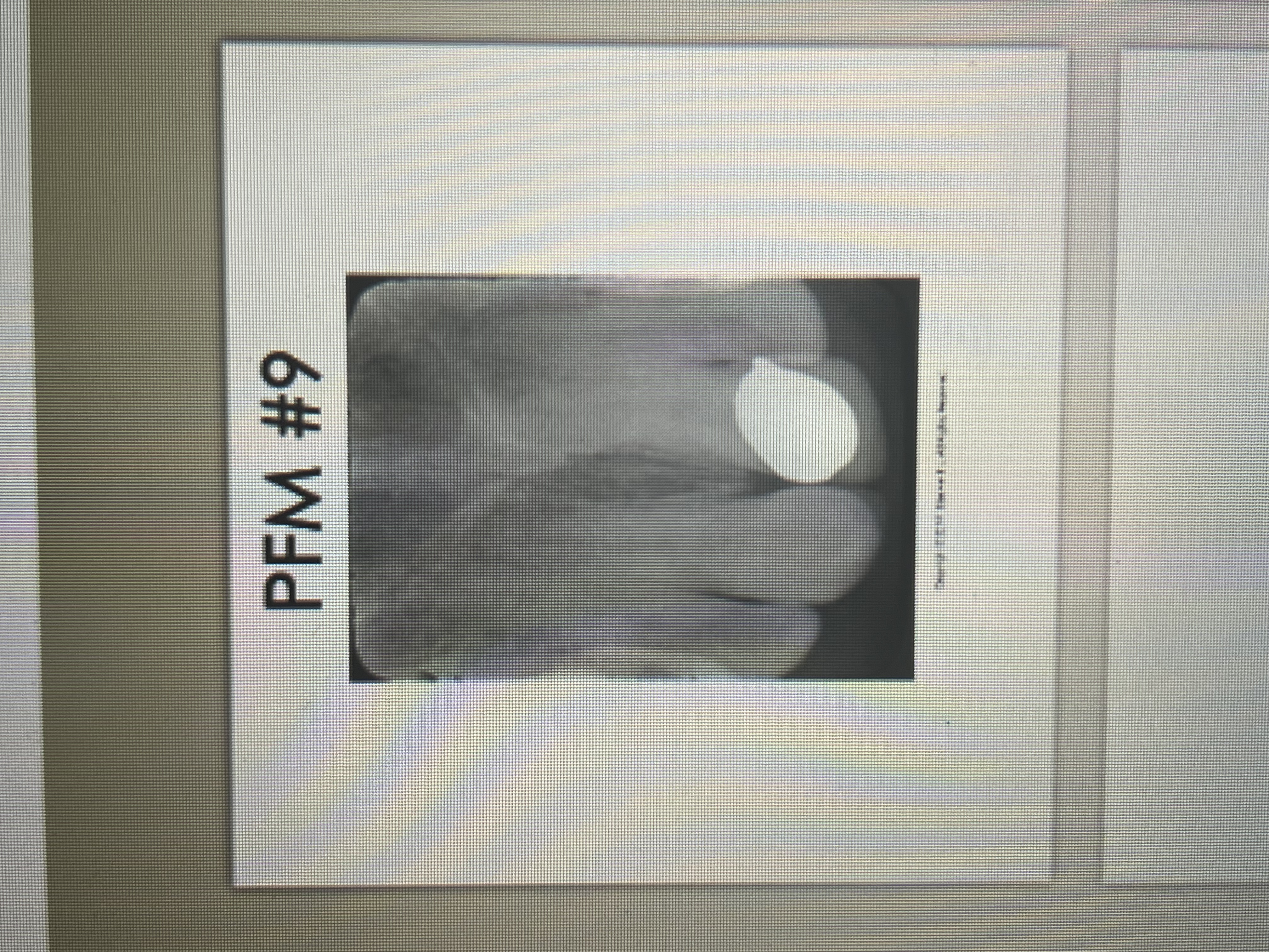 <p>Slightly radiopaque and resemble the radiodensity of dentin</p>