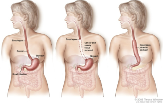 <p>What cancer esophageal management is this?</p>