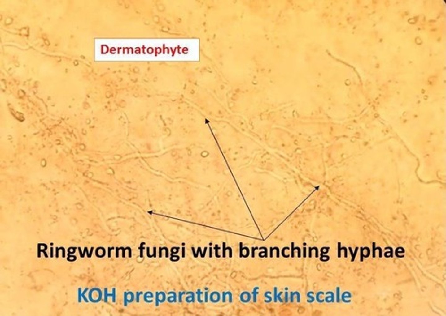 <p>- scraping part of a lesion from skin, hair or nails</p><p>- adding drops of KOH</p><p>- softens tissue; able to see fungal characteristics</p>
