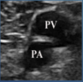 <p>What is site 6 of a DVT?</p>