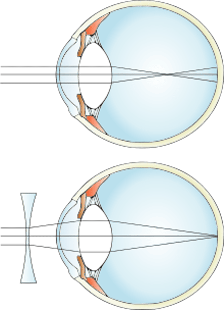 <p>A concave lens (or diverging lens)</p>