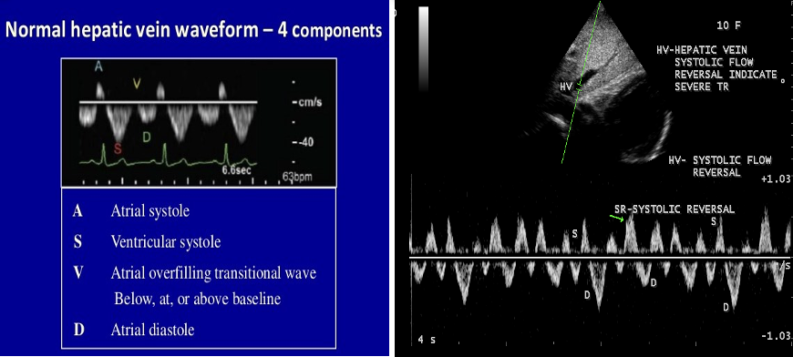 <p><span>The hepatic vein waveform can be __________________</span></p>