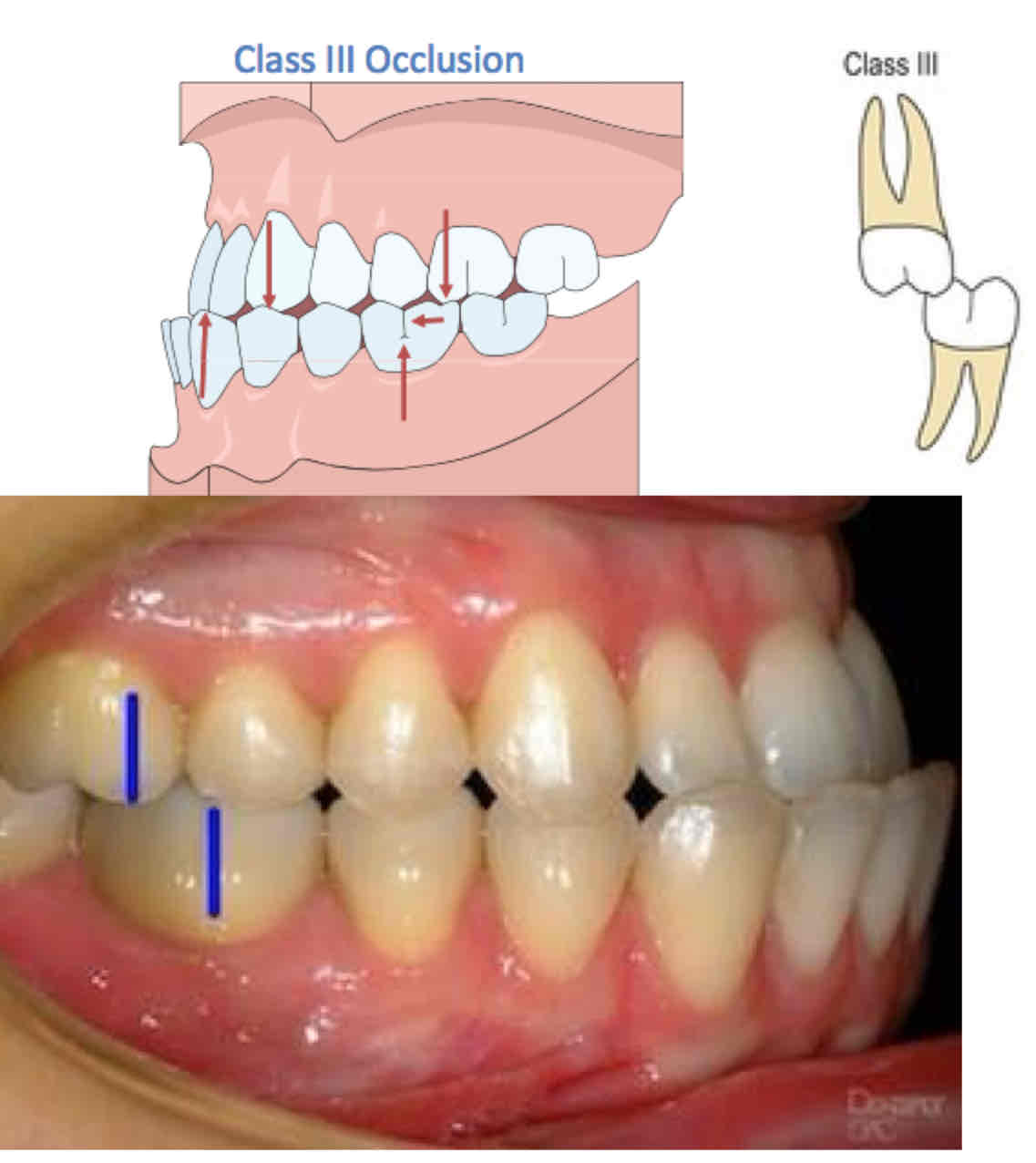 <p>what is class III occlusion (least common type)</p>