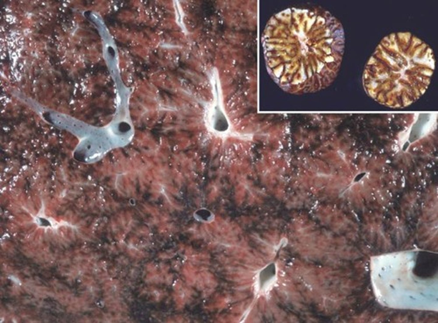 <p>prolonged damming of blood back in the liver --> liver oedema</p><p>hepatocellular hypoxia, necrosis, and fibrosis in the liver</p><p>results in the "nutmeg liver"</p>