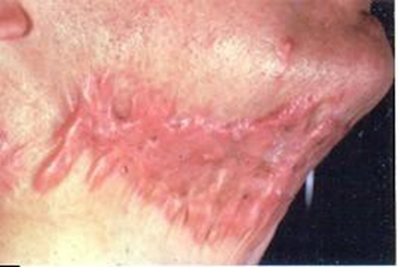A person suffering for the condition depicted in the figure is most commonly associated with which of the following?