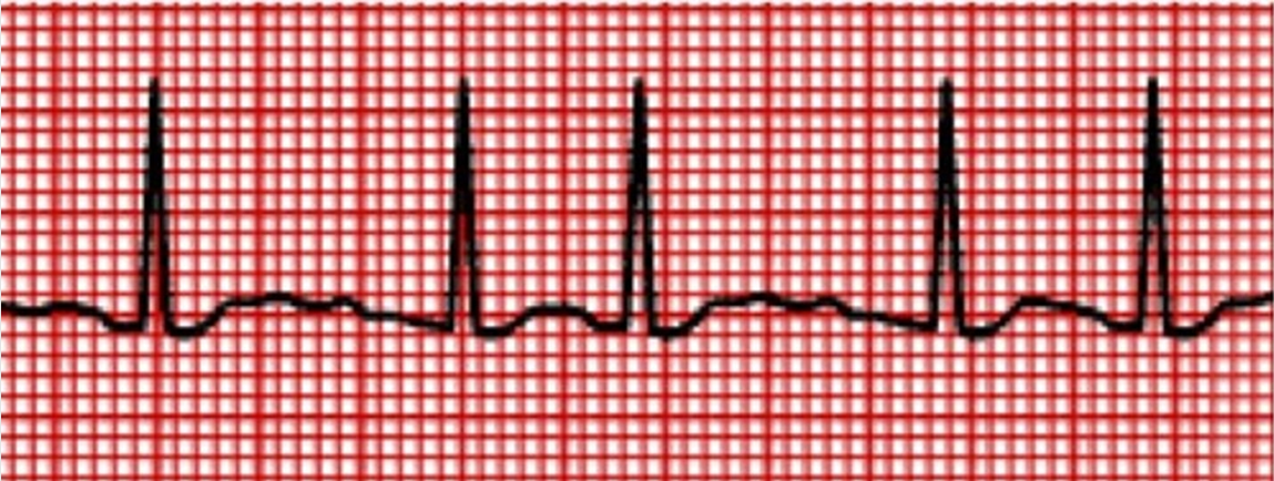 <p>What rhythm is this?</p><p>A. Multifocal atrial tachycardia</p><p>B. Atrial fibrillation</p><p>C. Wandering Atrial pacemaker</p><p>D. Atrial flutter with variable conduction</p>