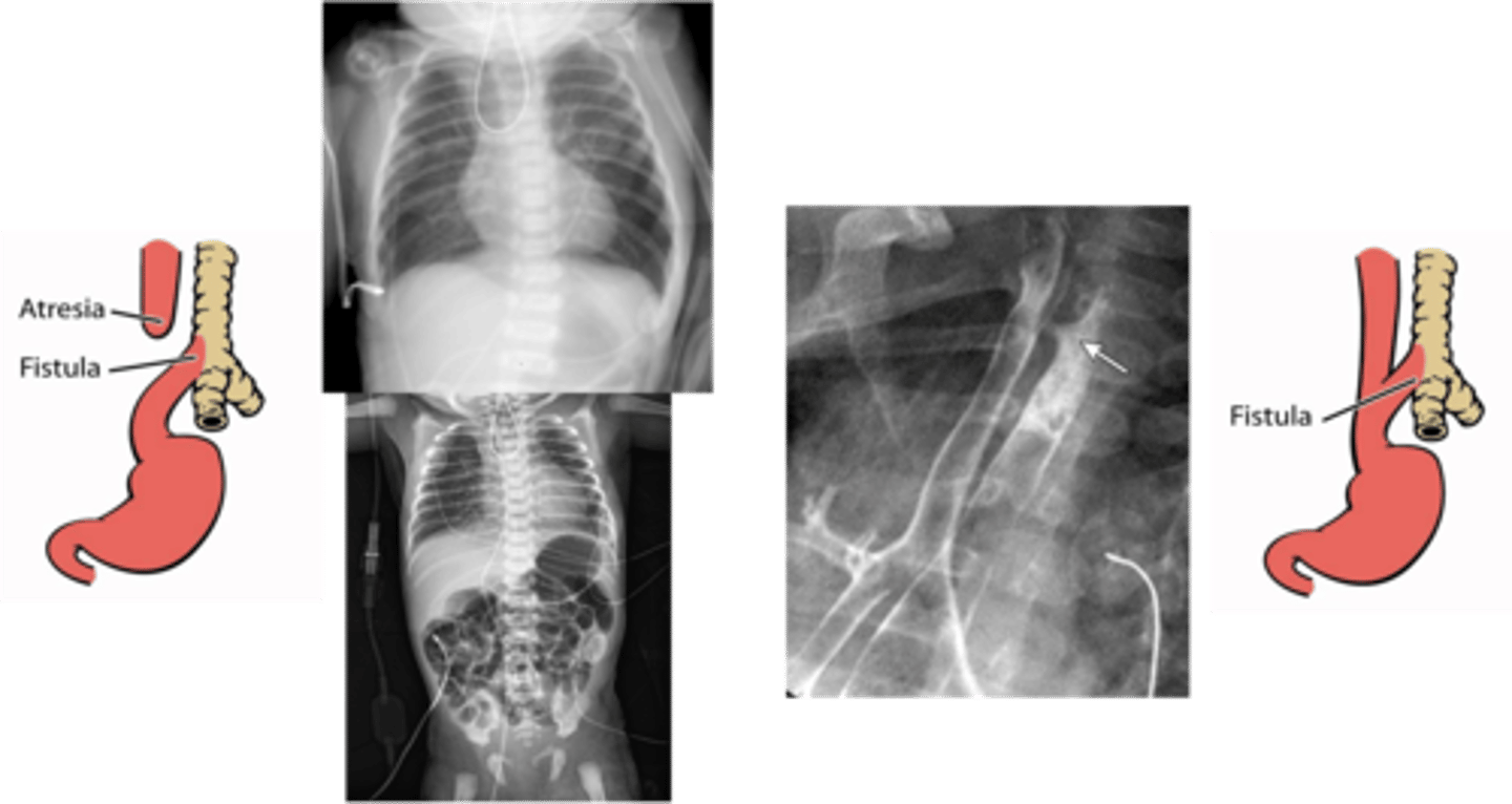 <p>Define Condition:</p><p>Congenital anatomic abnormality in which there is a connection between the trachea and the esophagus</p><p>-Hx: AFTER BIRTH (first few days of life)</p><p>-Path:</p><p>&gt; 85% = Esophageal Atresia + Distal TEF</p><p>&gt; 4% = Pure TEF (H-Type)</p><p>-Sx/PE:</p><p>BOTH: (VACTERL) - 50% of pts have one or more of these:</p><p>&gt; Vertebral Anomalies</p><p>&gt; Anal Atresia</p><p>&gt; Cardiac Malformations</p><p>&gt; TEF</p><p>&gt; Renal Anomalies</p><p>&gt; Limb Defects (radius and/or thumb)</p><p>Esophageal Atresia (d/t EXTREMELY short GI tract)</p><p>&gt; Choking</p><p>&gt; Drooling</p><p>&gt; Inability to Feed</p><p>&gt; Abdominal Distension (stomach &amp; intestines filled with air)</p><p>&gt; Gastric Acid Reflux (may cause Aspiration Pneumonia &amp; Respiratory Difficulties)</p><p>Pure TEF (H Type)</p><p>&gt; Milk/Formula/Gastric Secretions move into Trachea ==&gt; Coughing, Choking, Resp Distress, Aspiration Pneumonia</p><p>&gt; BURPING (Gas moves easily through INTACT esophagus)</p><p>-Dx:</p><p>Esophageal Atresia (d/t EXTREMELY short GI tract)</p><p>&gt; Prenatal Ultrasound</p><p>&gt;&gt; Esophageal Atresia = POLYHYDRAMNIOS</p><p>&gt; CXR &amp; Catheter</p><p>&gt;&gt; Coiling = atresia of Esophagus</p><p>&gt; Plain CXR</p><p>&gt;&gt; Esophageal Atresia + Gas-filled GI Tract = EA-TEF</p><p>Pure TEF (H Type)</p><p>&gt; Water-soluble contrast study</p><p>&gt; Endoscopy/Bronchoscopy</p><p>-Tx:</p><p>&gt; Pure TEF = Opening in esophagus and trachea sewn closed</p><p>&gt; EA-TEF = Esophageal segments surgically connected to each other</p>