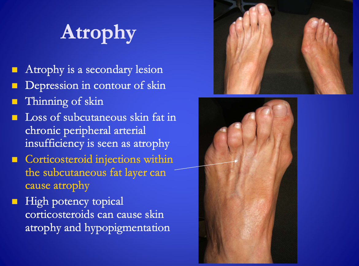 <p><span>Atrophy</span>: depression in contour of skin</p><ul><li><p><span><strong>[...]</strong></span> within the subcutaneous fat layer can cause atrophy&nbsp;</p></li><li><p>Is a secondary lesion</p></li></ul><p></p>